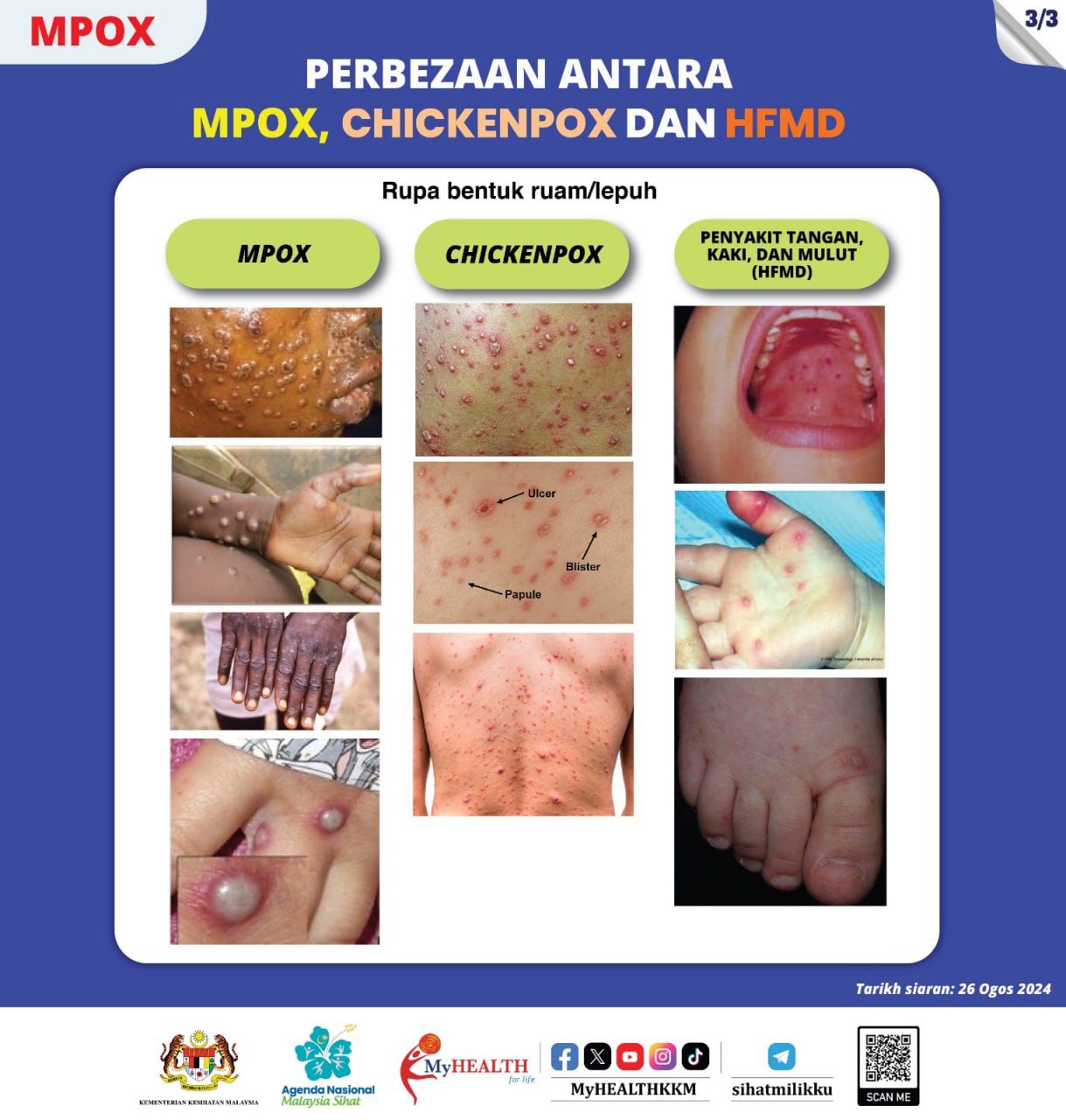 beza mpox chickenpox hfmd 03